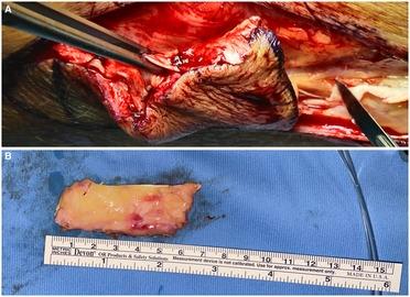 Case report: Endoscopic closure with double stenting and autologous fascia lata graft of large tracheo-esophageal fistula